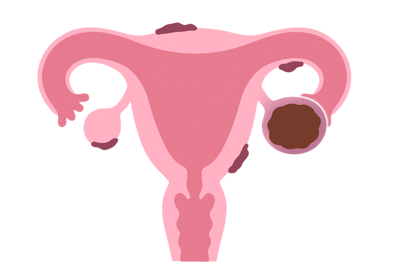 子宮内膜症とは？