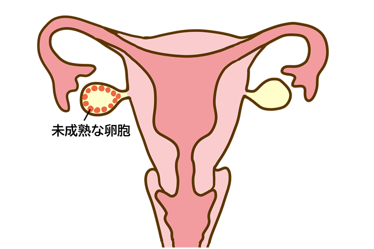多嚢胞性卵巣症候群とは？