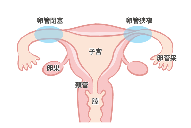 卵管閉塞（卵管狭窄）