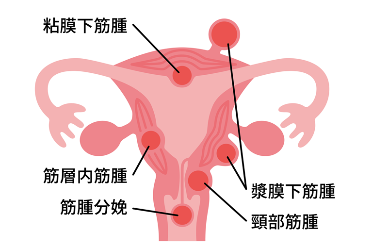 子宮筋腫とは？